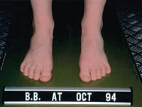 leg length correction leg length correction